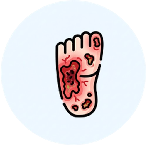 Úlceras, heridas agudas y crónicas